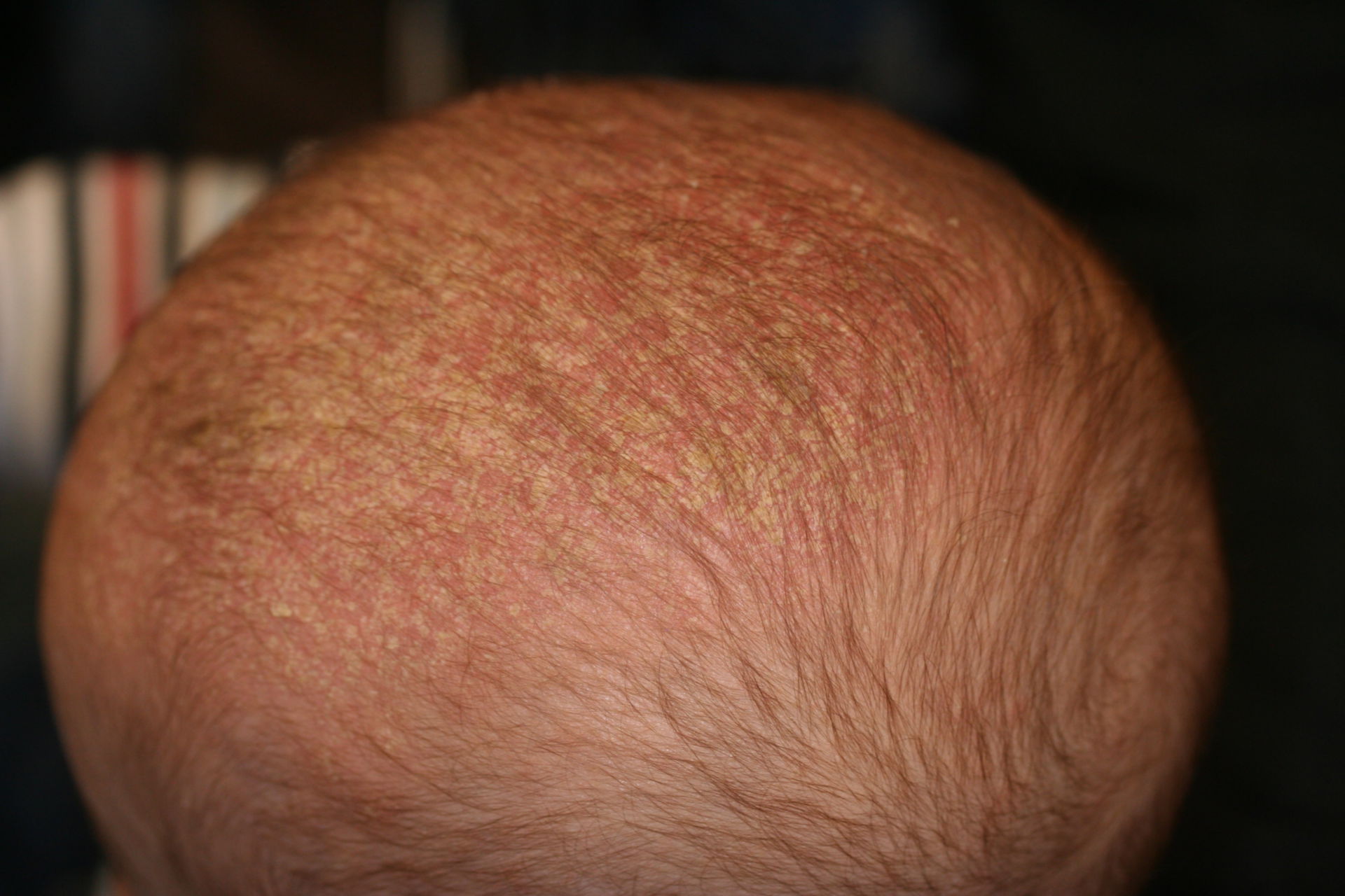 Eczema seborroico della testa in un bambino