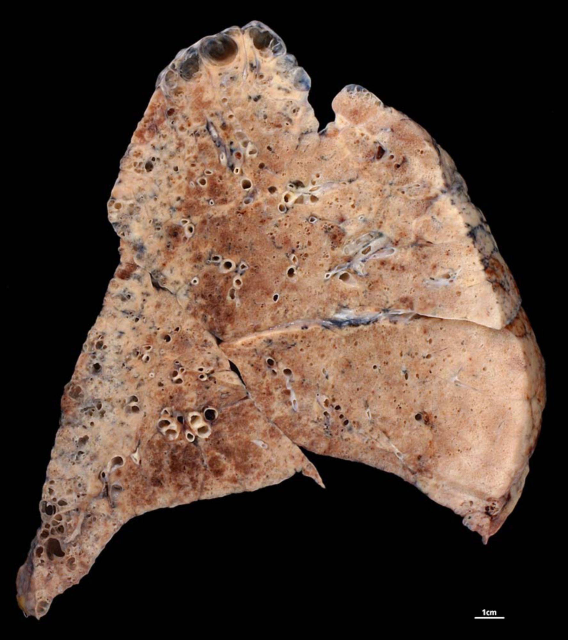 Lung fibrosis in a patient with rheumatoid arthritis