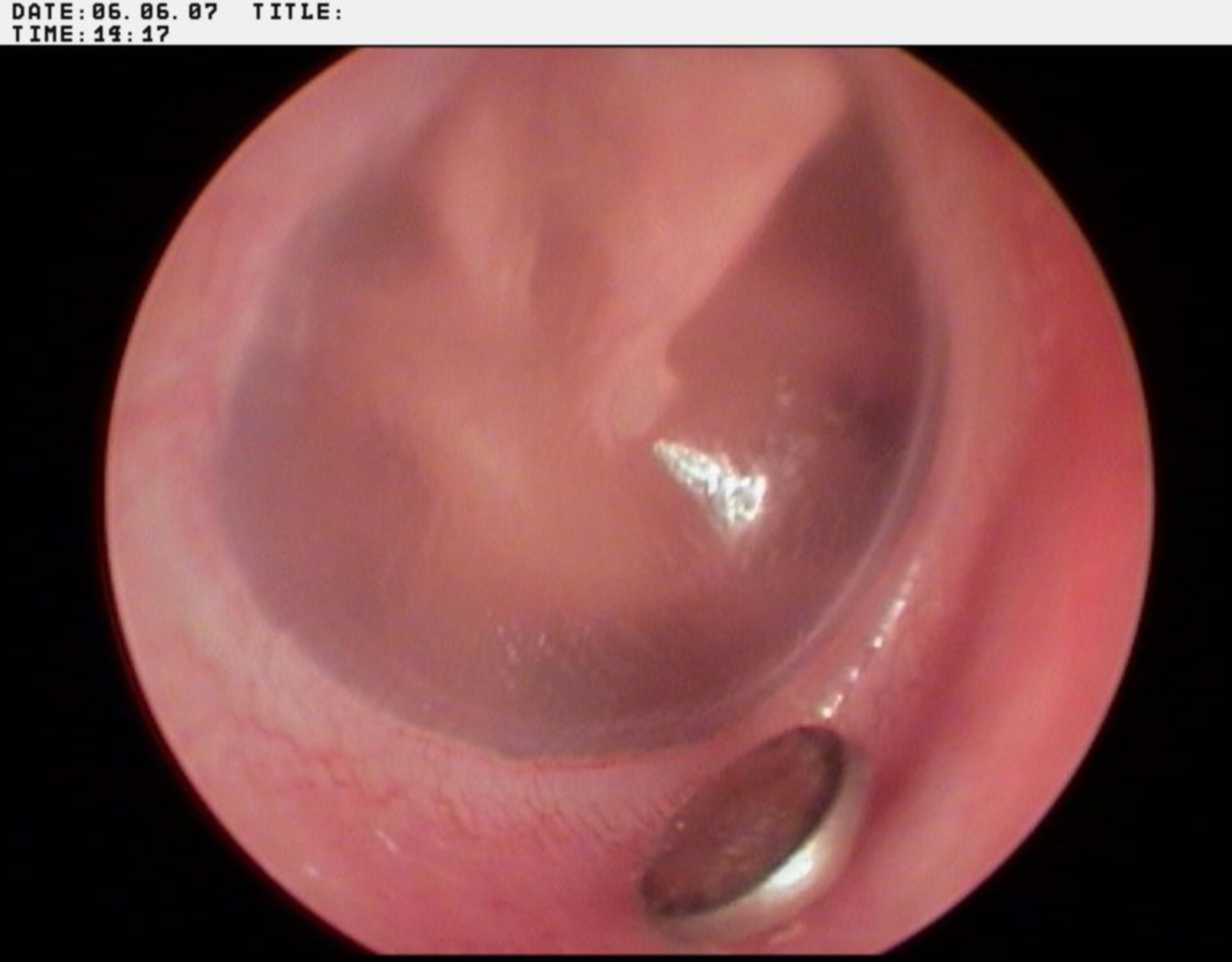 Foreign body in the ear
