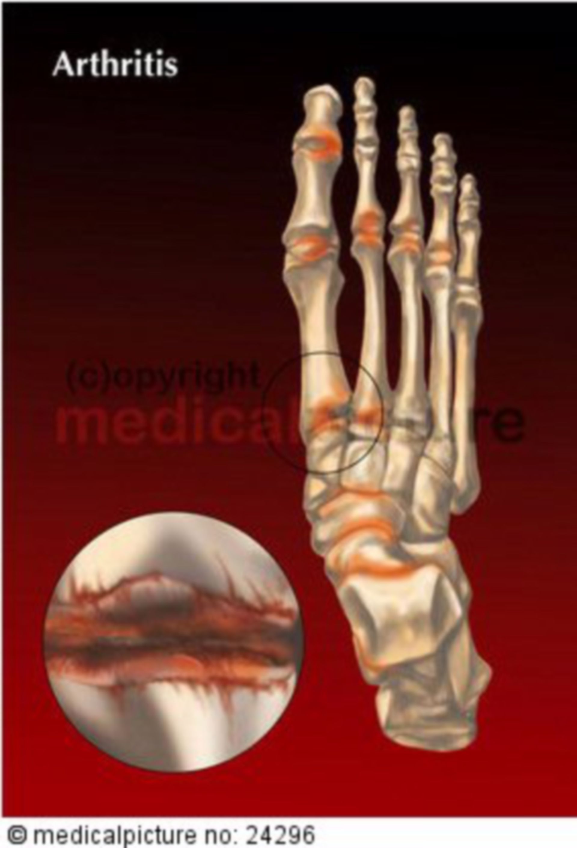  Menschliches Fußskelett mit Arthritis 
