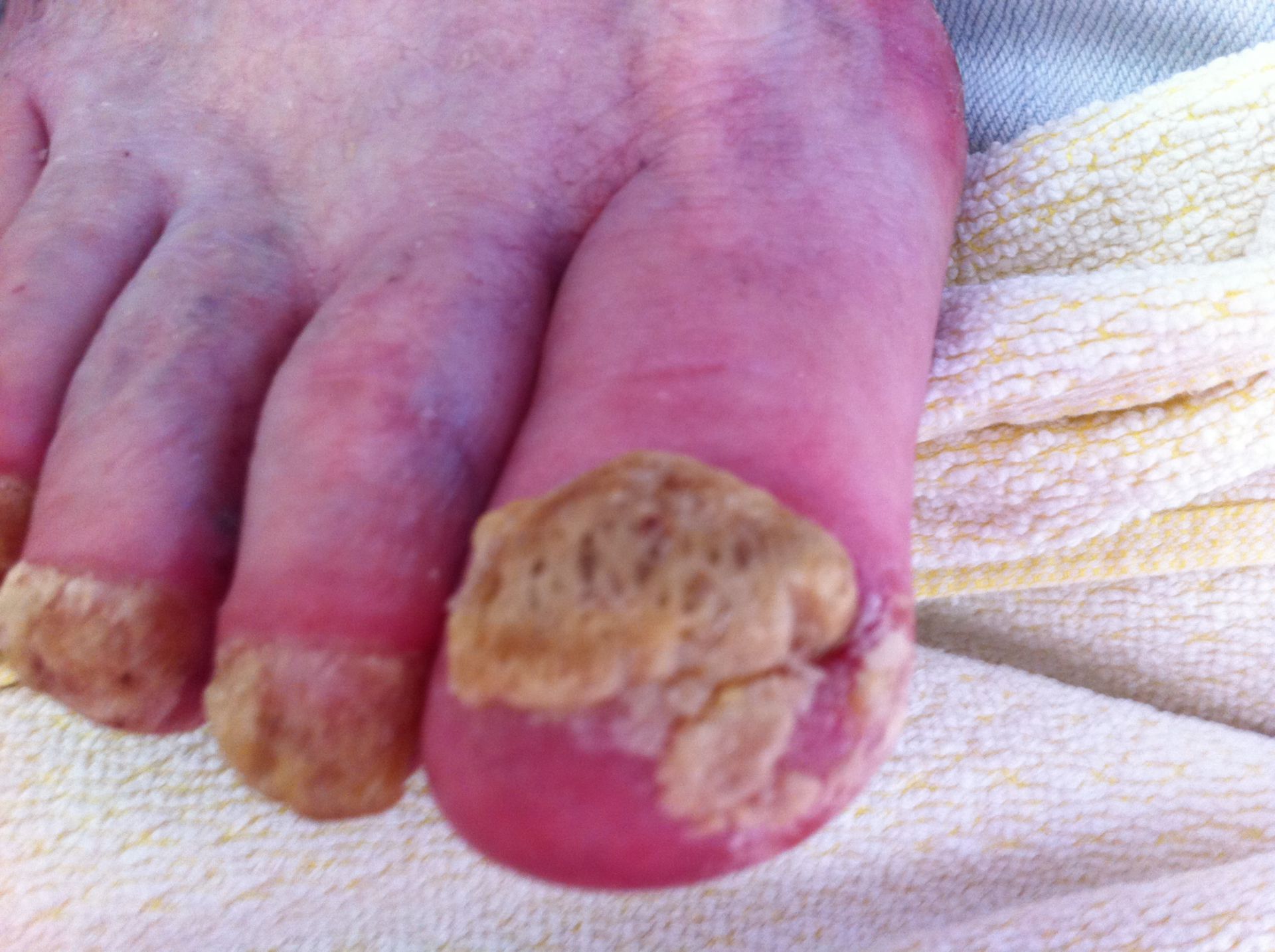 Crumbling nail in psoriasis