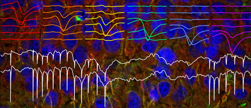 Diese Bildcollage zeigt im Hintergrund einzelne Nervenzellen (Zellkerne sind blau gefärbt). Im Vordergrund sind Messkurven der elektrischen Aktivität abgebildet. Bei Störung des Kv7-Kaliumkanals sind Nervenzellen hyperaktiv, was an schnell aufeinanderfolgenden Ausschlägen zu erkennen ist. © DZNE/Stephan Marguet und Malte Stockebrand