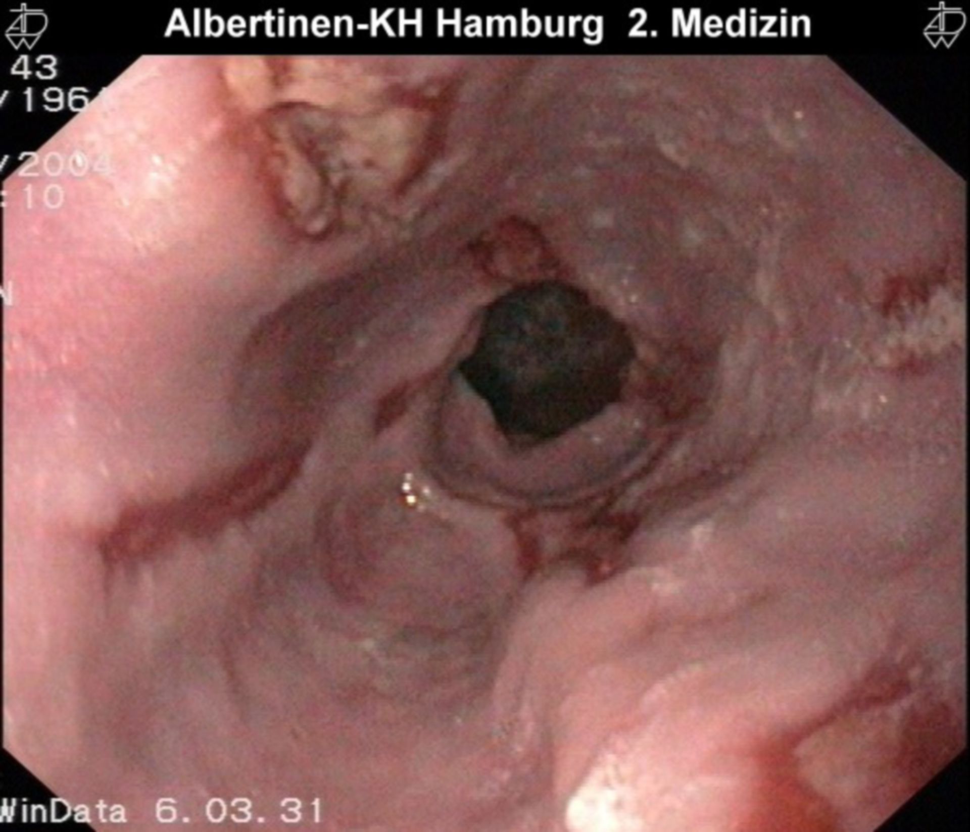 Esophagitis thoracic stomach