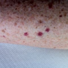 Purpura chronica progressiva DocCheck Flexikon