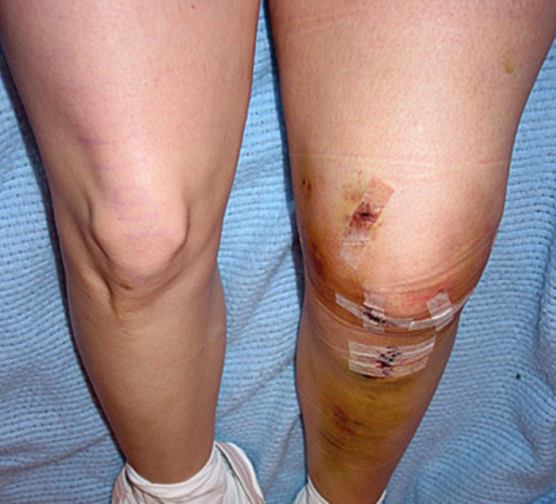 ACL reconstruction (hamstring autograft)
