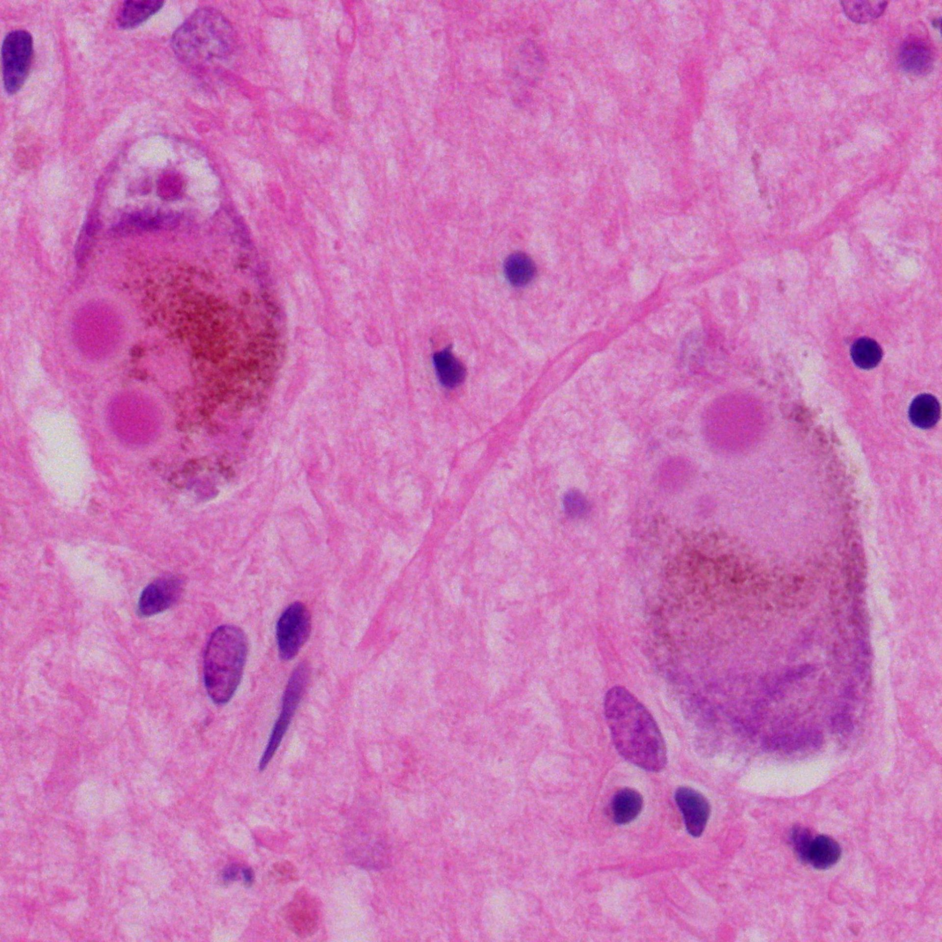 Lewy bodies (substantia nigra)