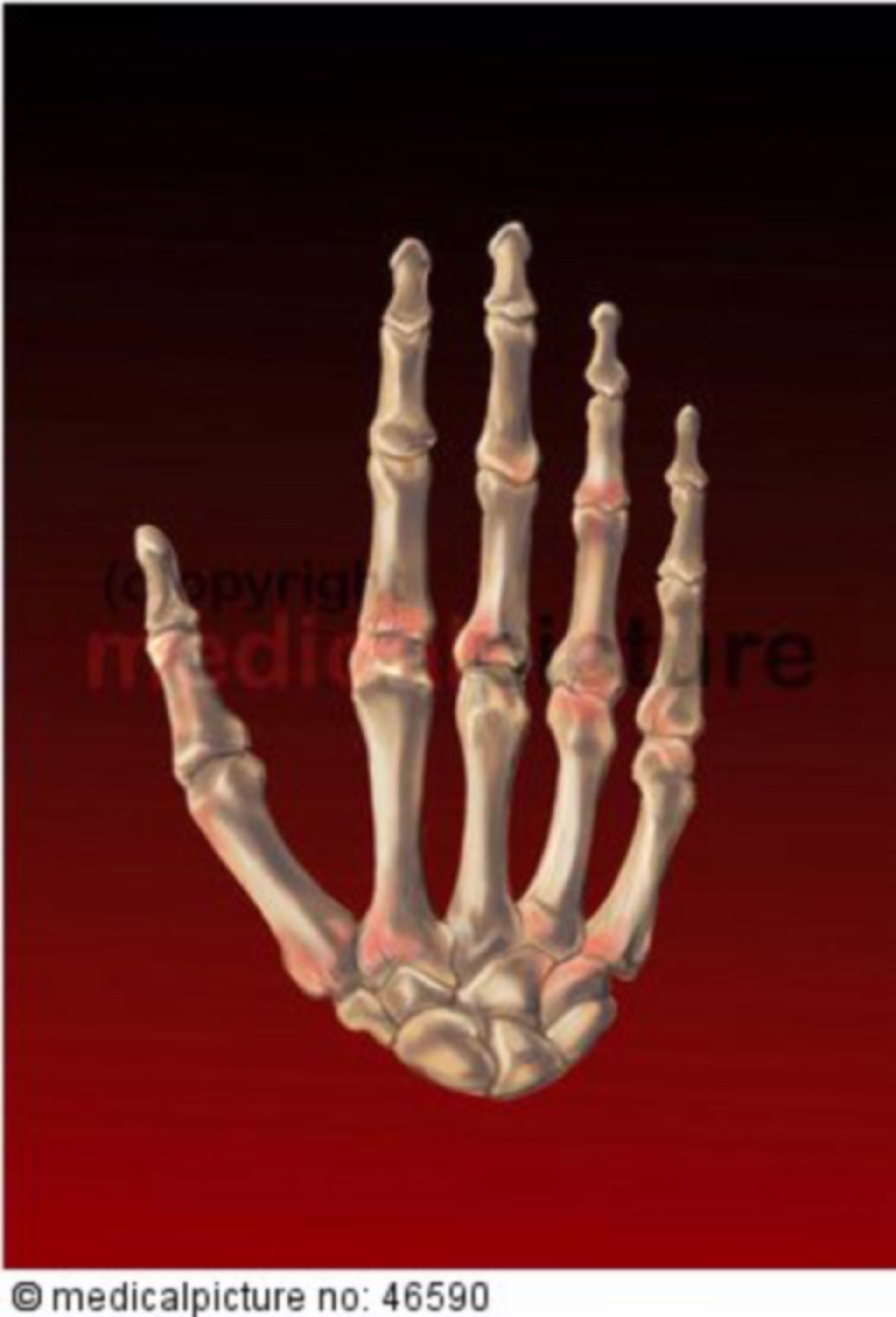 Hand skeleton with arthritis