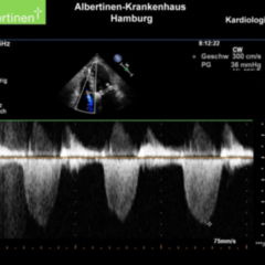 Ligamentum pulmonale - DocCheck Flexikon