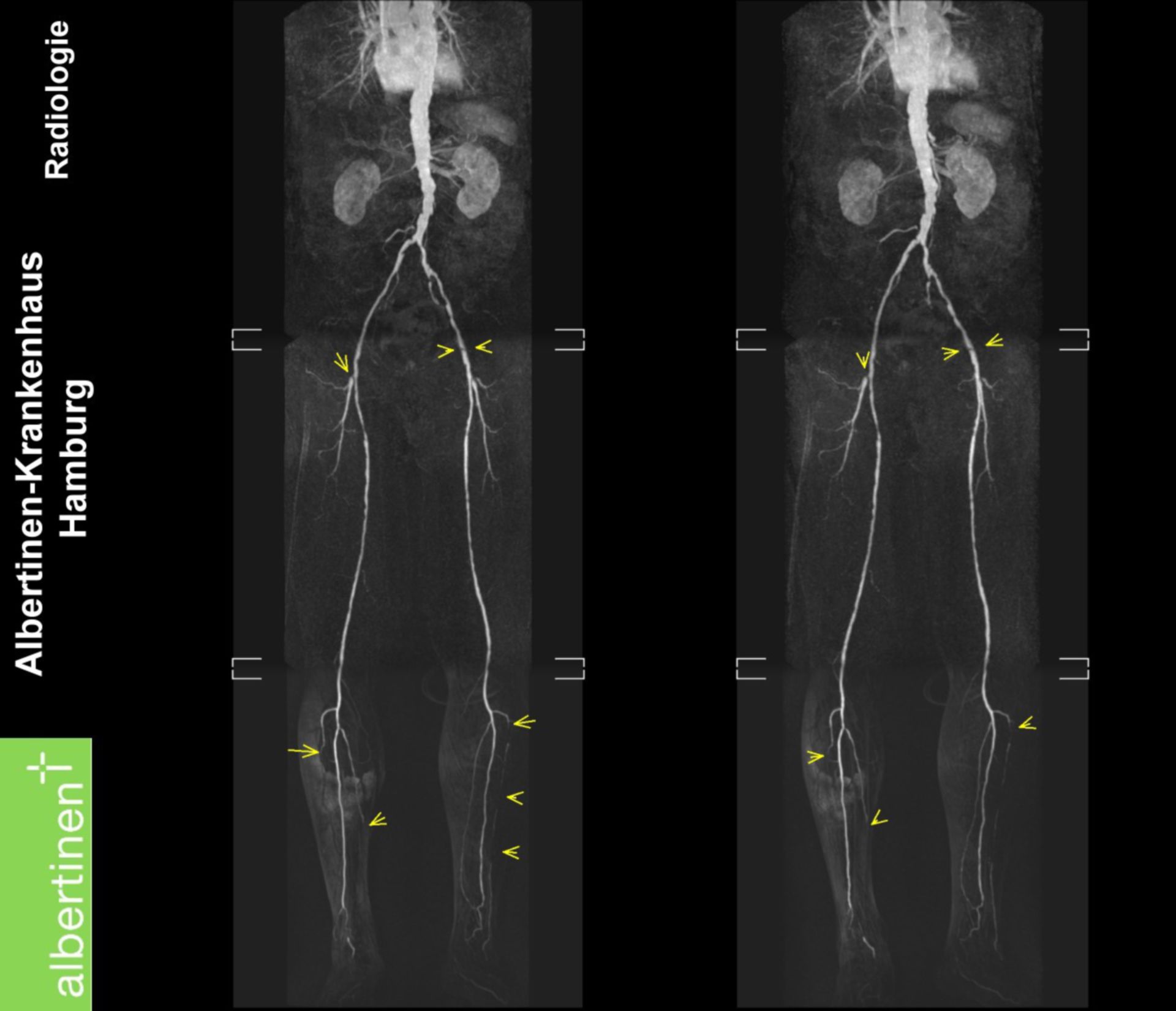 MRI: peripheral vascular disease of the leg arteries