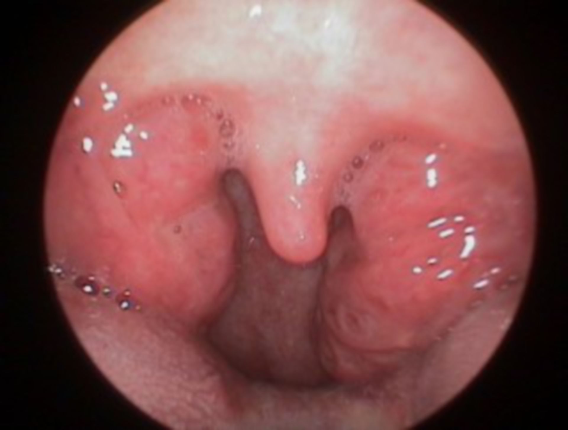 Large tonsils