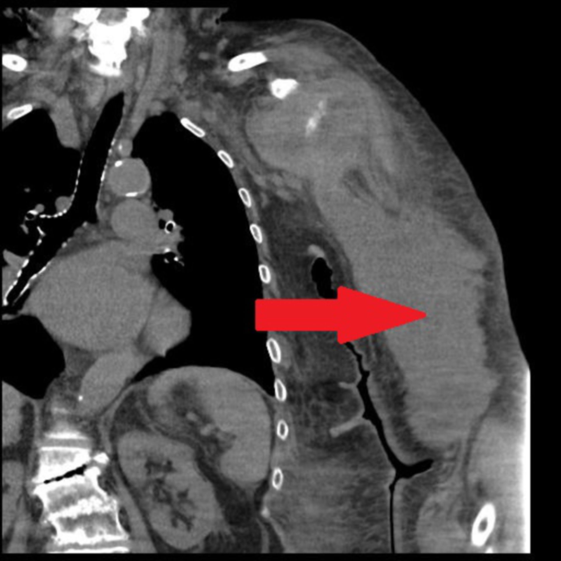 CT des Oberarmes links mit unregelmäßig begrenzter Raumforderung ventral des Humerus