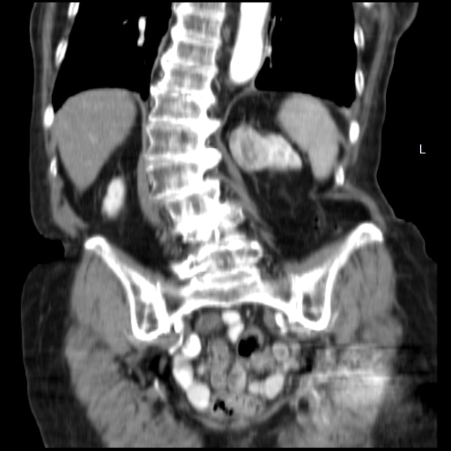 ct_abdomen5: CT Abdomen in frontaler Ebene