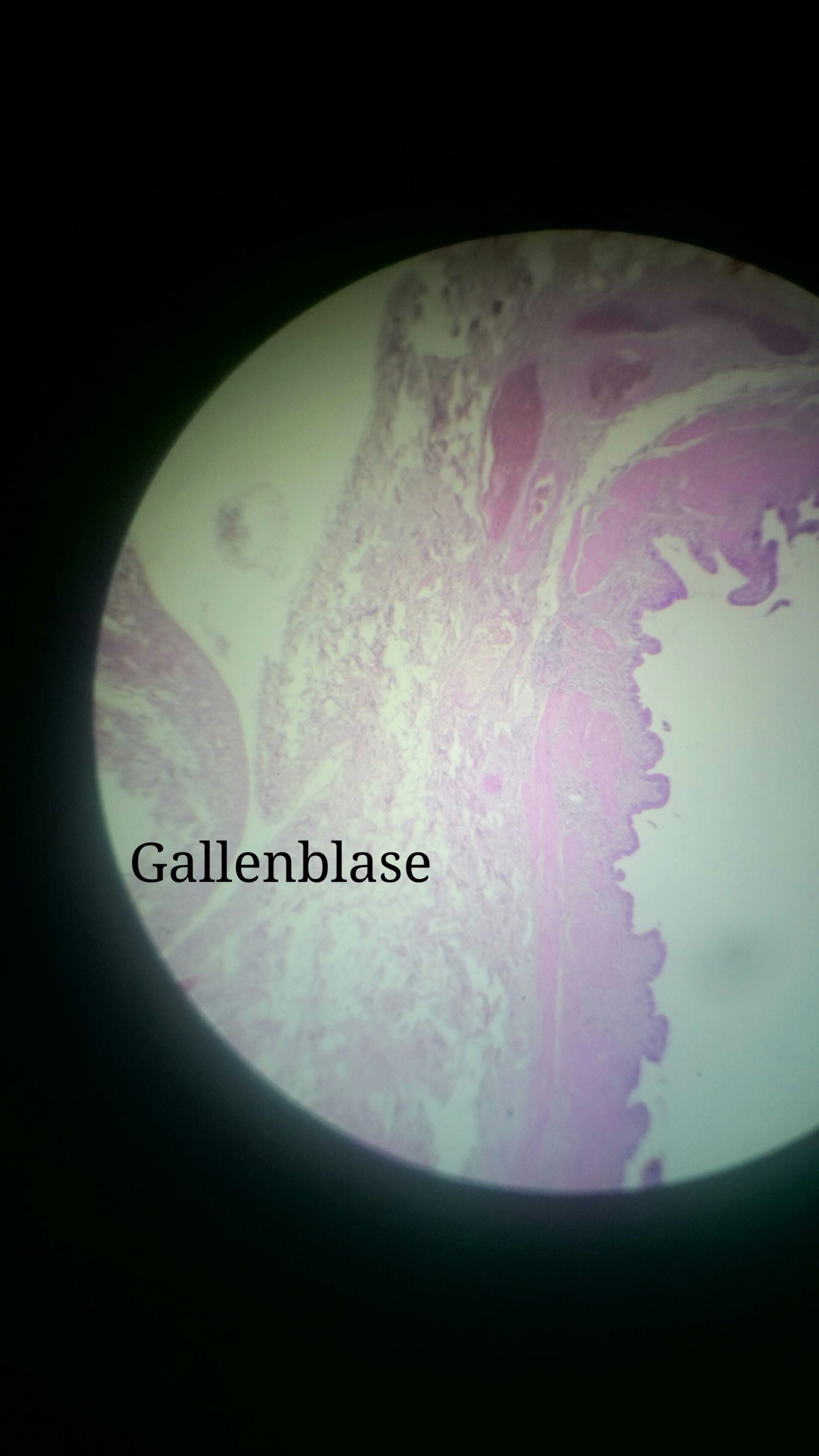 Gallenblase1
