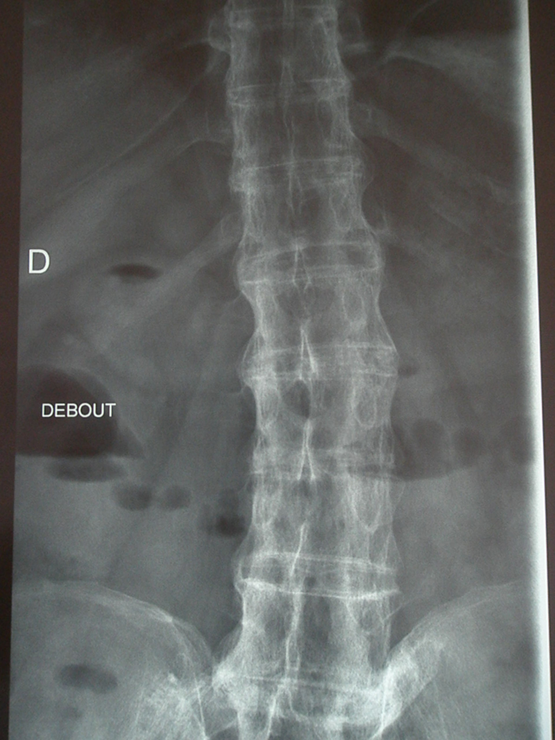 Spondilite anchilosante, colonna vertebrale a bamboo