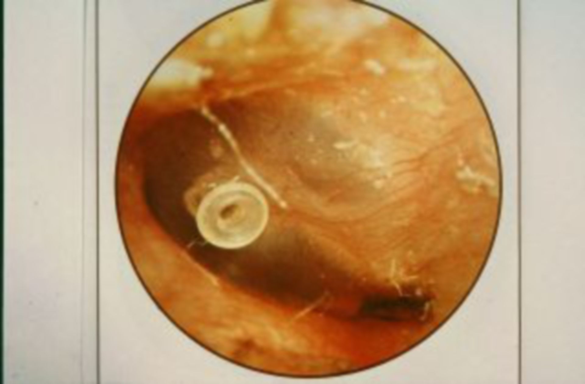 Paukenr hrchen Bei Otitis Media Mit Erguss Bei Kindern JRRMO
