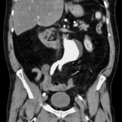 Thorakales Aortenaneurysma Doccheck Flexikon