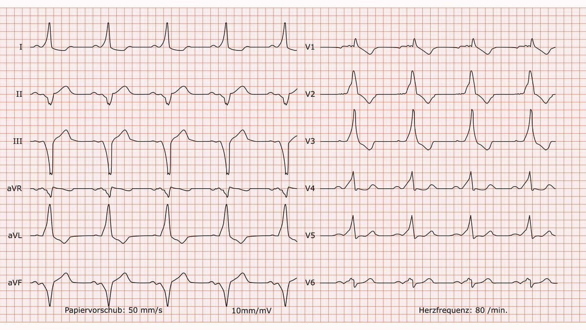 12-Kanal-EKG bei Wolff-Parkinson-White-Syndrom
