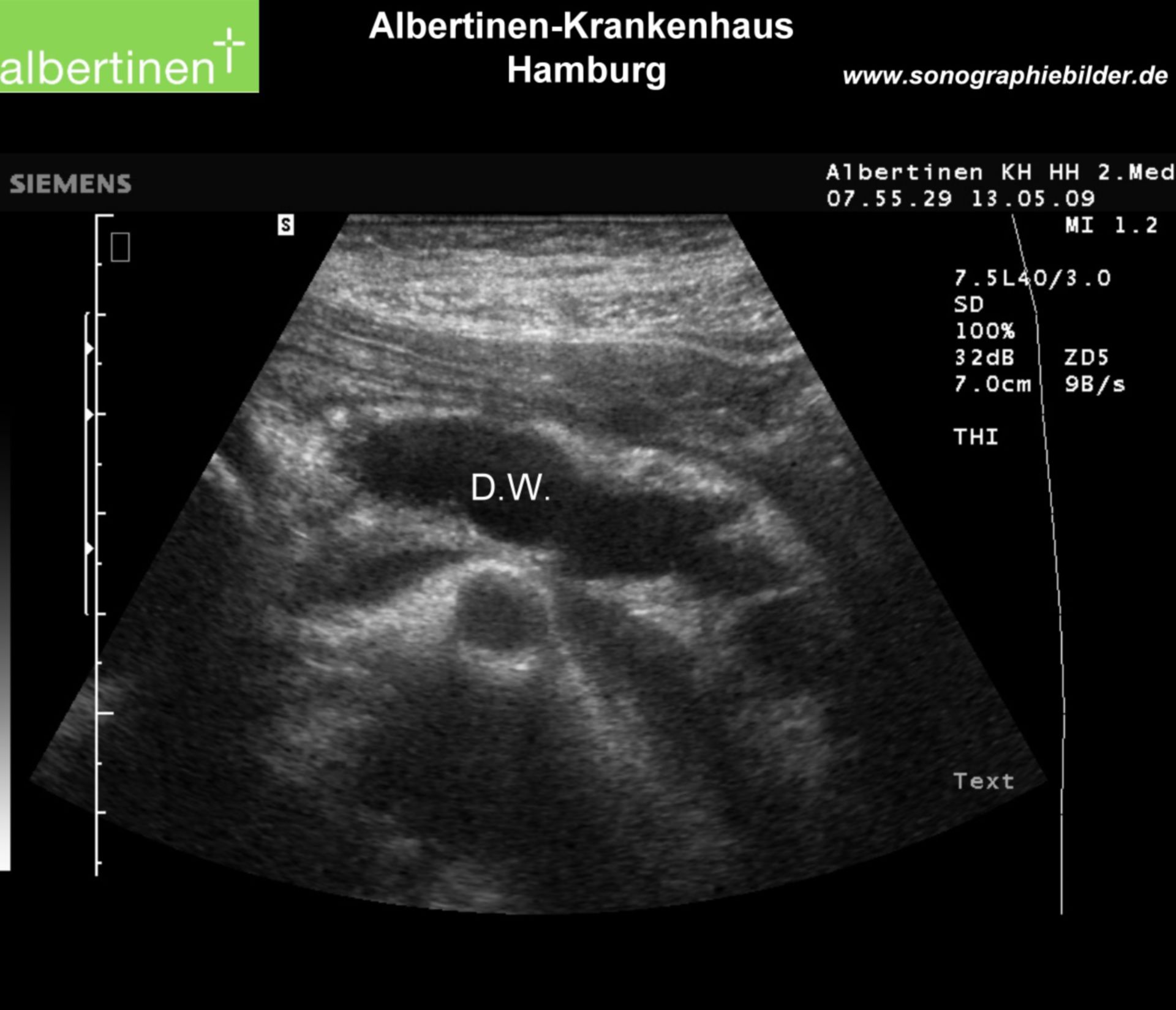 Chronic pancreatitis with dilated duct (ultrasound, text)