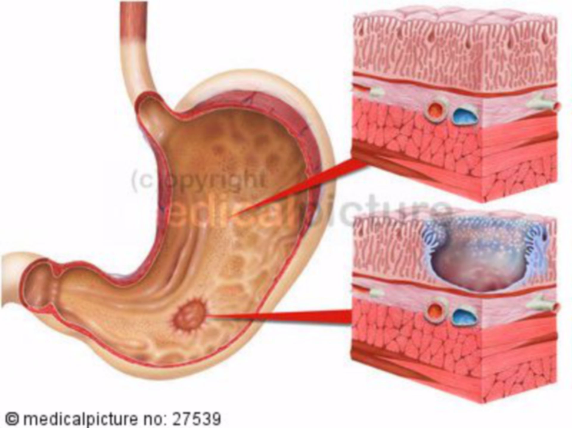 Gastric Ulcer, Ulcus Ventriculi