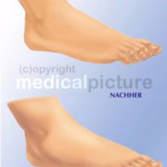 Prätibiales Ödem - DocCheck Flexikon
