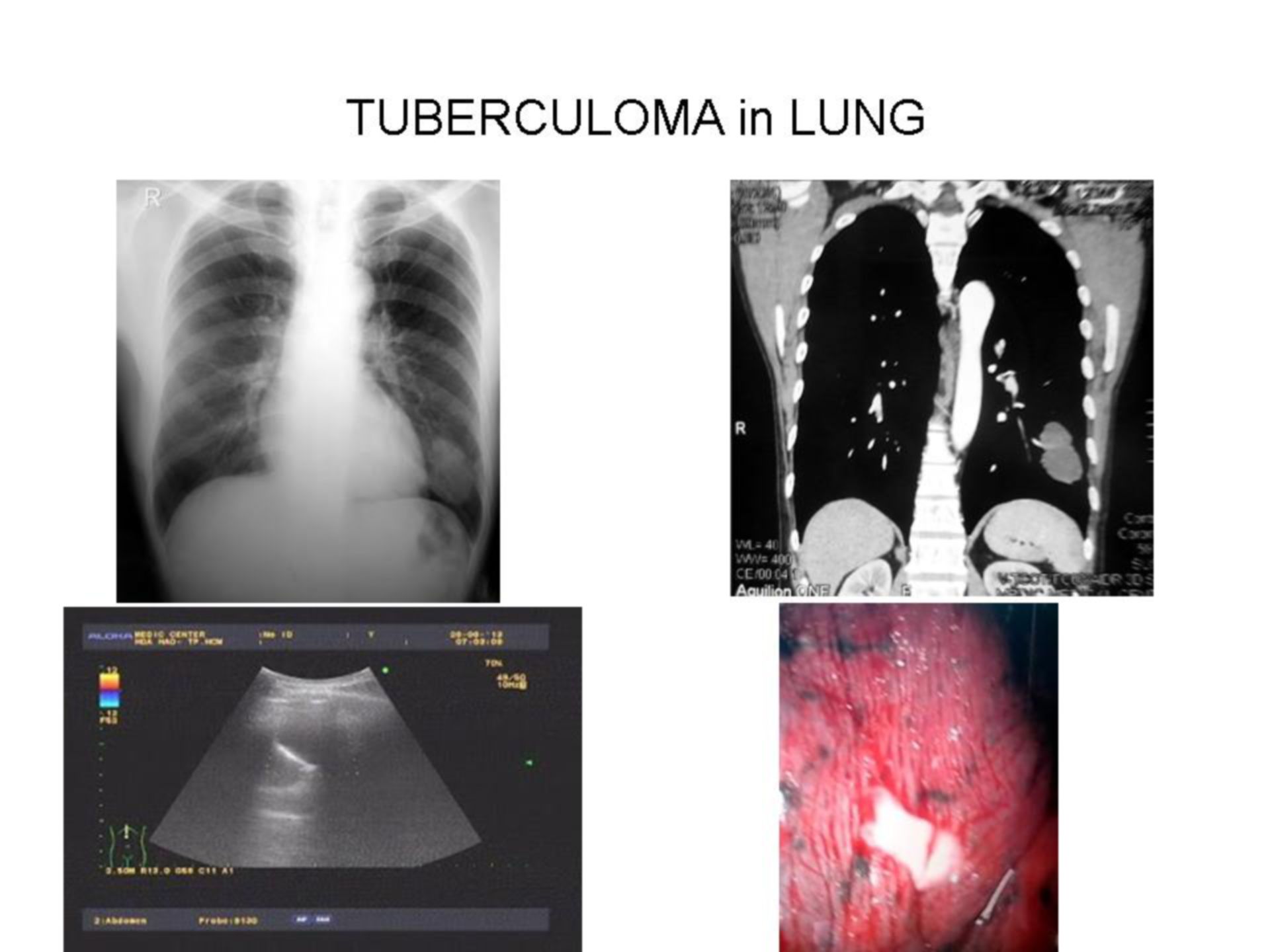 Lung tuberculoma