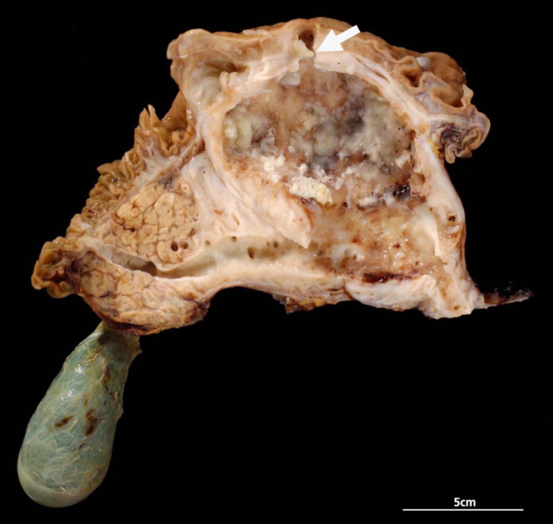 Intraduktaler papillärer muzinöser Tumor des Pankreashauptganges