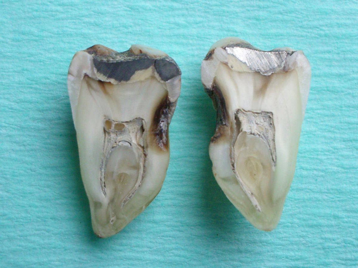 Kariöser Zahn mit Pulpastein