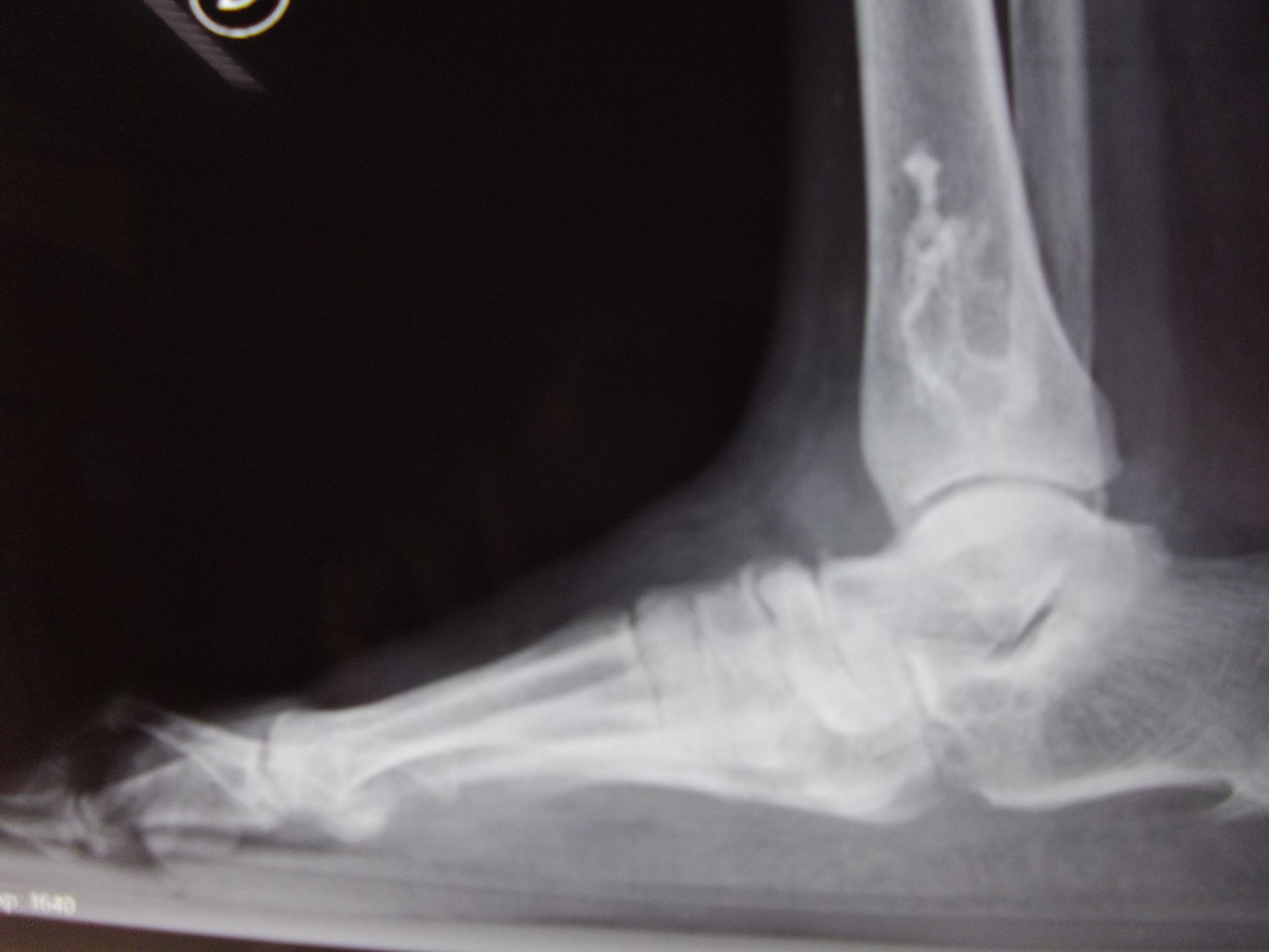 Fuß Osteoarthritis und Knocheninfarkt