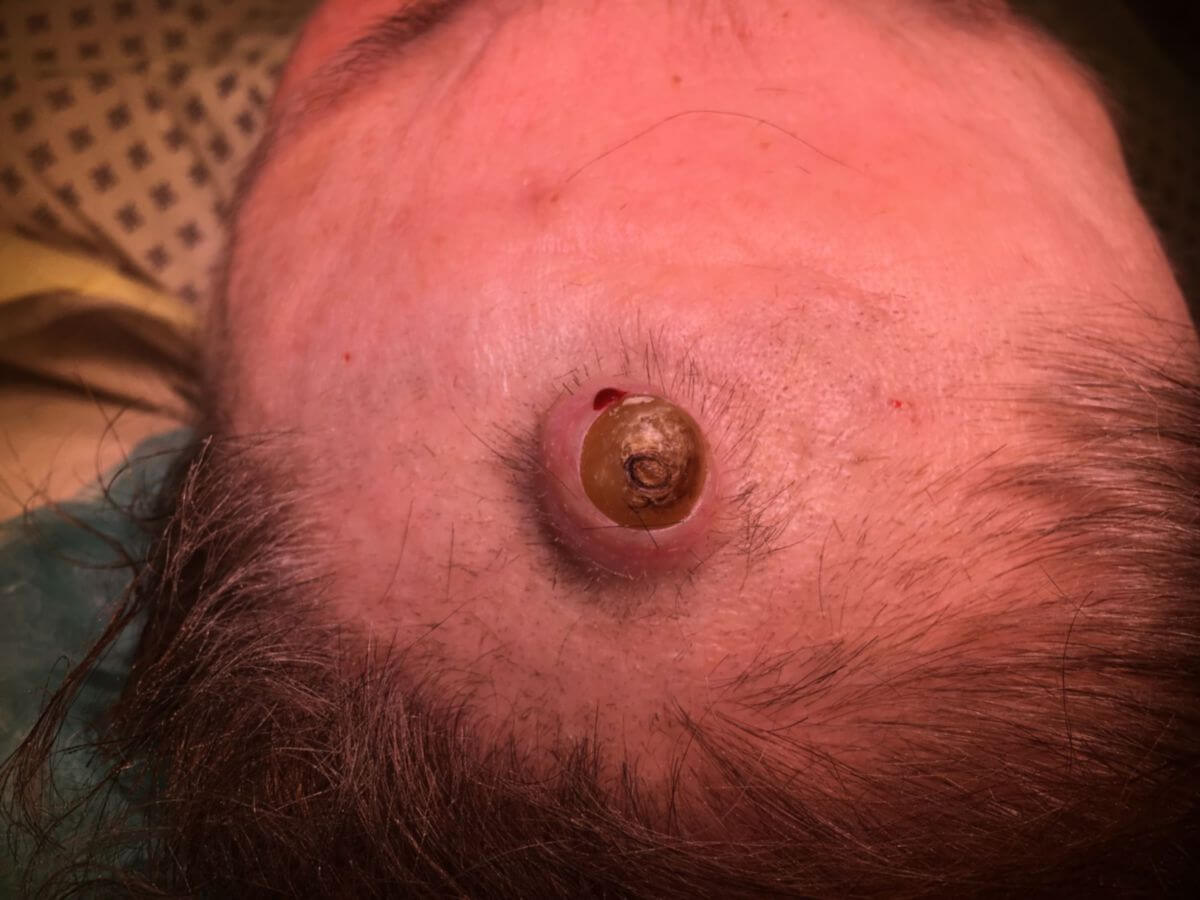 Befund eines Pilomatrixom