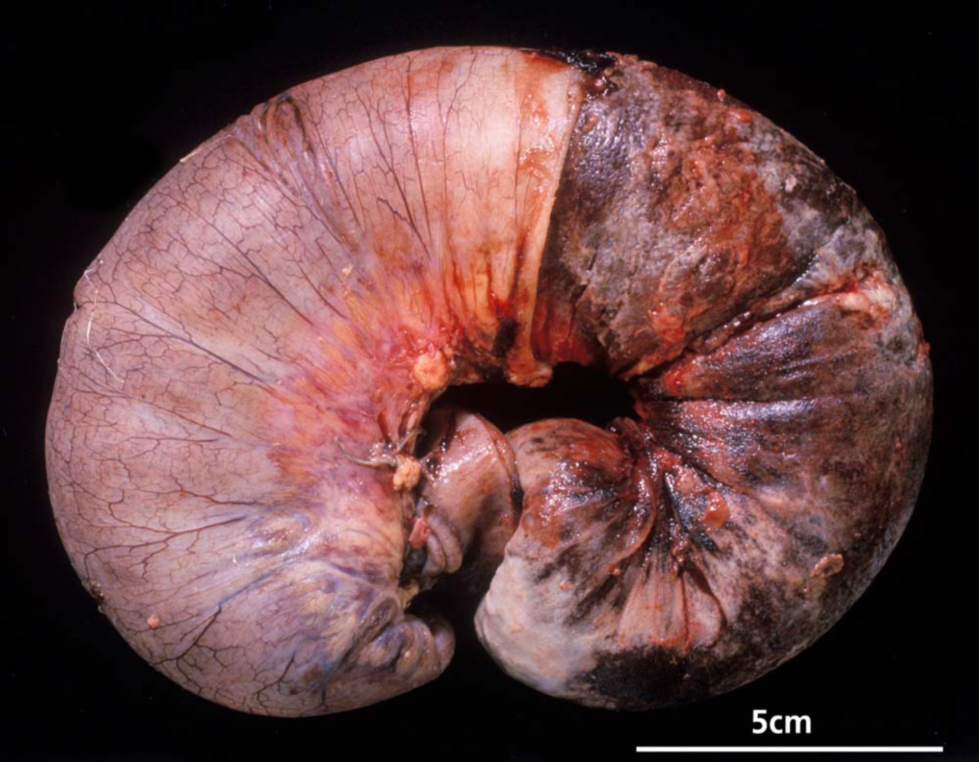Dünndarminvagination bei Peutz Jeghers Polyp