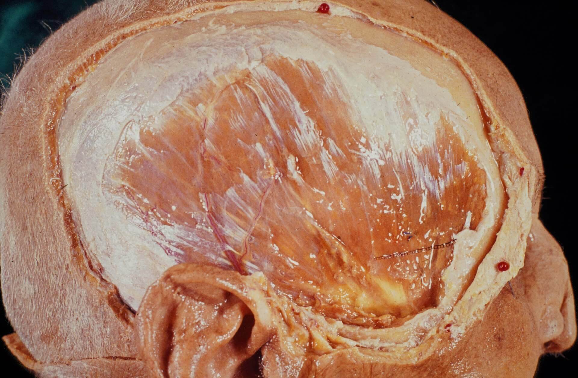 Musculus temporalis