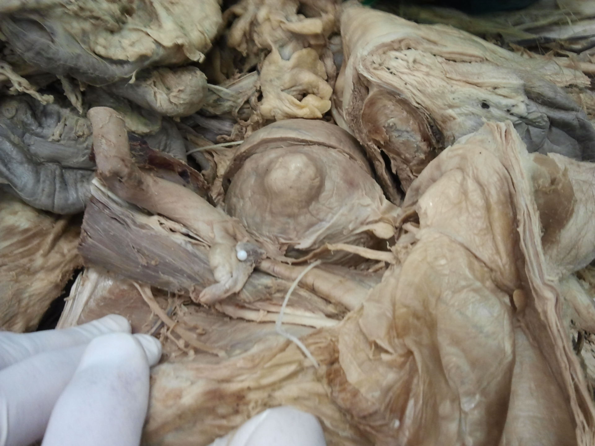 Arteria Iliaca rechts