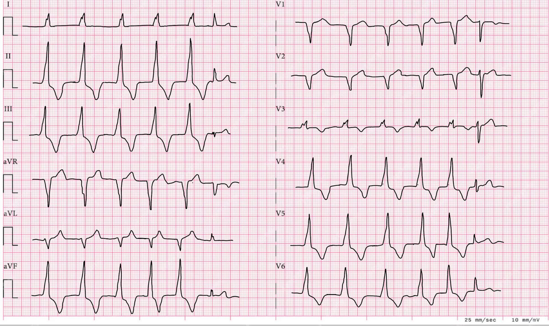 Akzelerierter idioventrikulärer Rhythmus mit Capture Beat