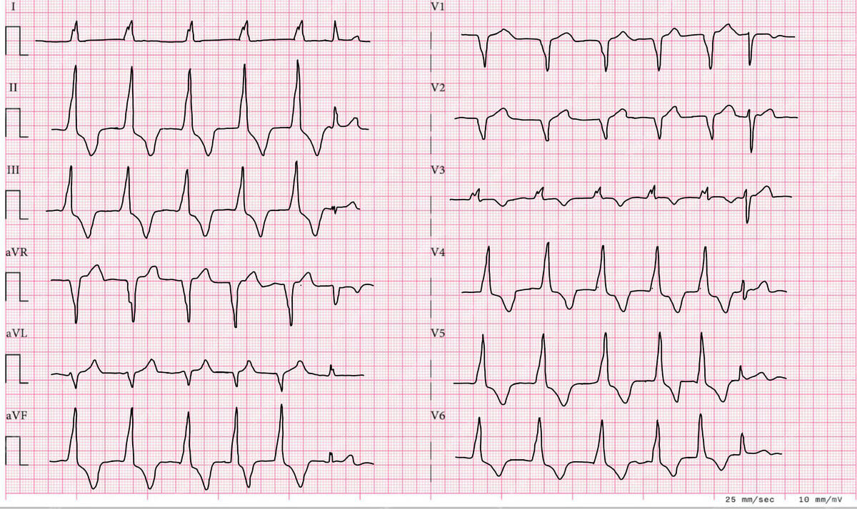 Akzelerierter idioventrikulärer Rhythmus mit Capture Beat