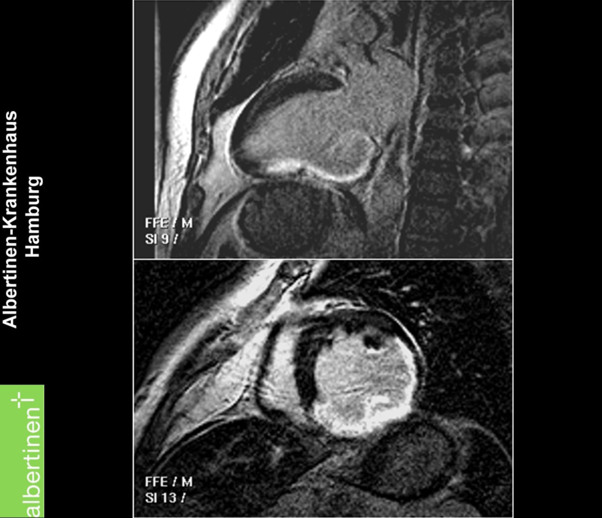 MRI: Posterior infarction