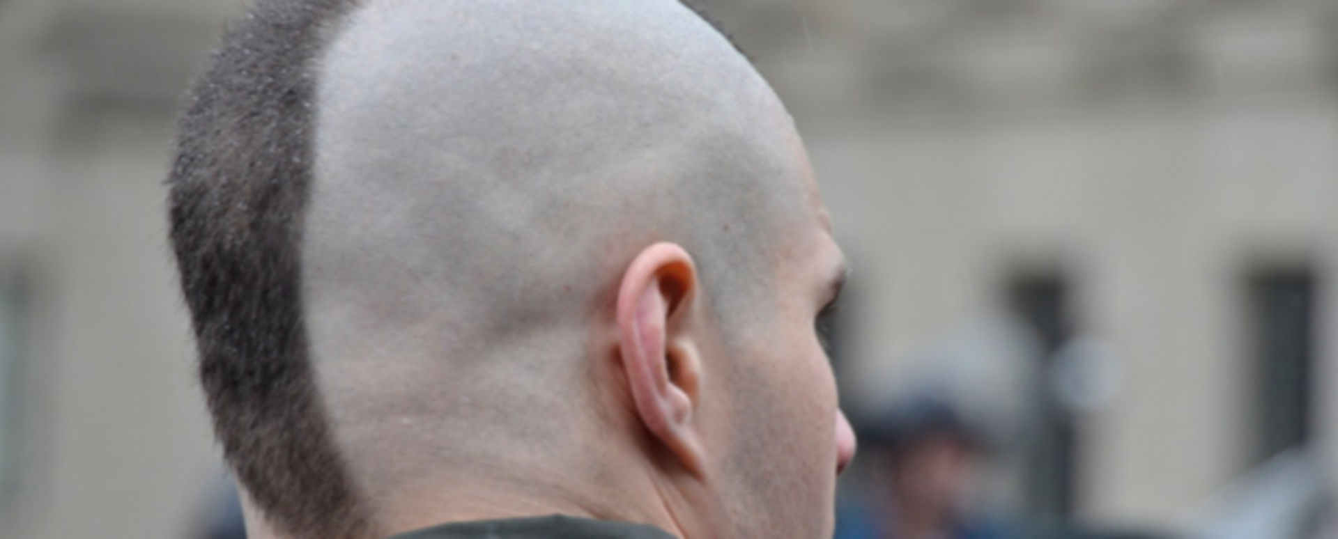 Alopecia areata Ein neues Glatzinib DocCheck