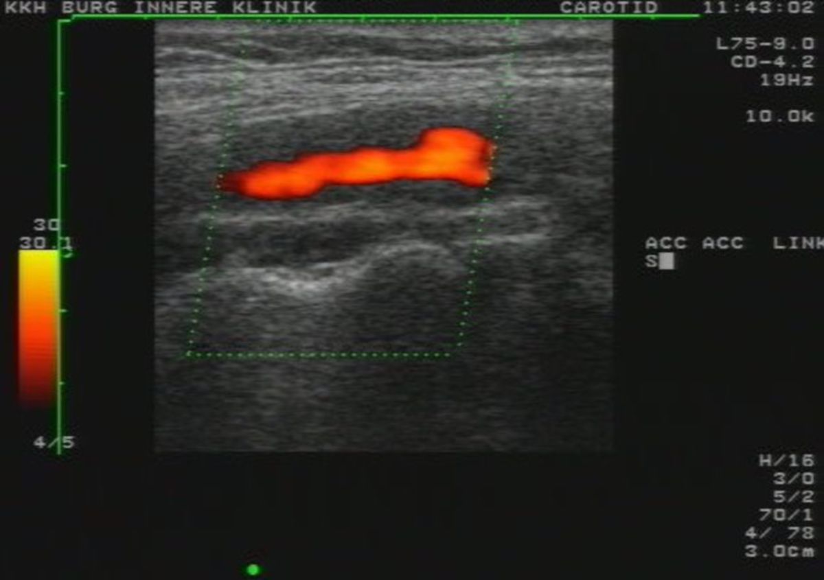 Takayasu arteriitis