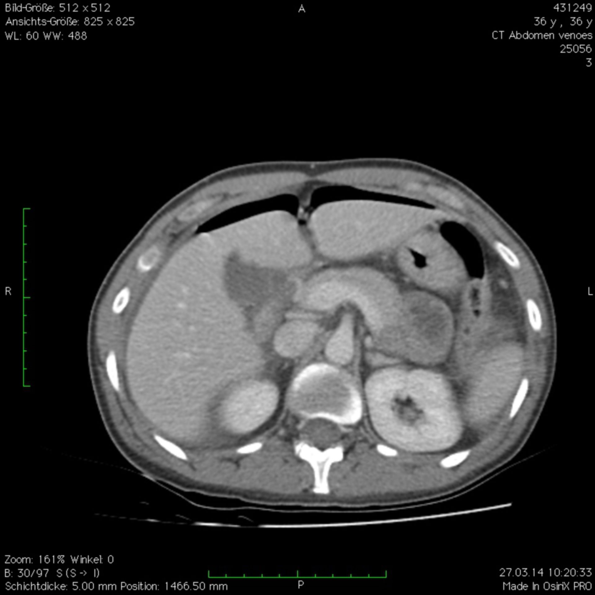 Abdominal CT: air in the abdominal cavity