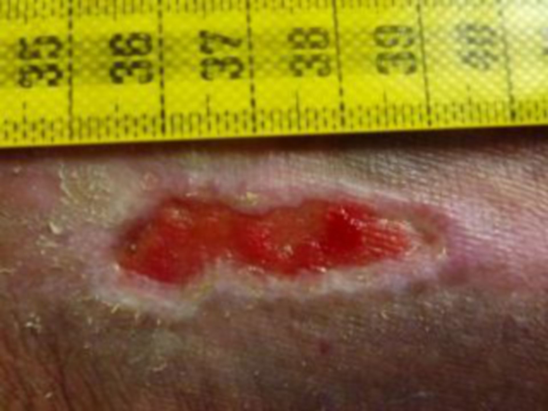 (13) wound care: thrombosis, ulcers of the lower leg  - condition on the day of discharge