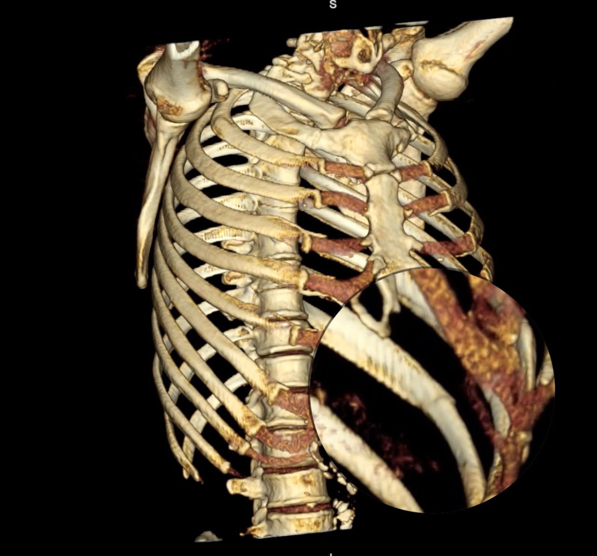 3D-Rekonstruktion einer CT des Thorax mit Ansicht von ventral mit Rippenfraktur