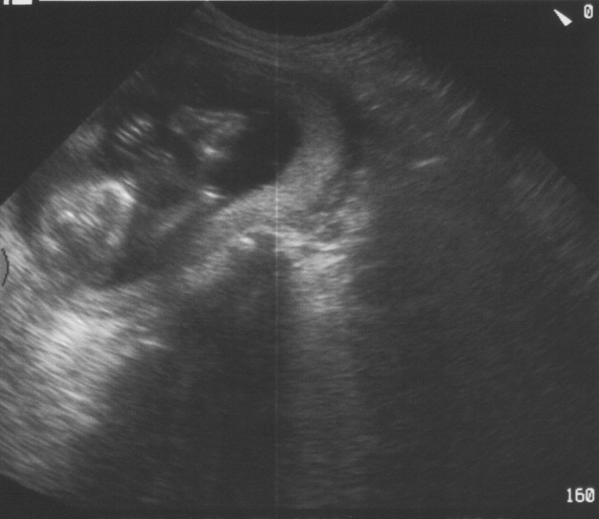 Ultrasound - 16 weeks pregnant