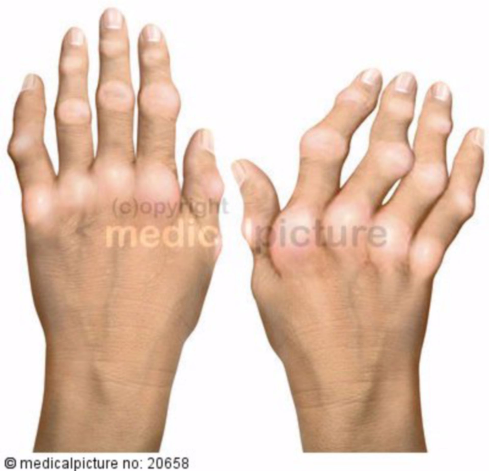 Deformierte Hände infolge rheumatoider Arthritis