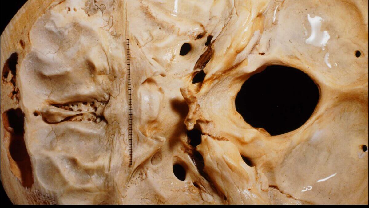 Foramen magnum