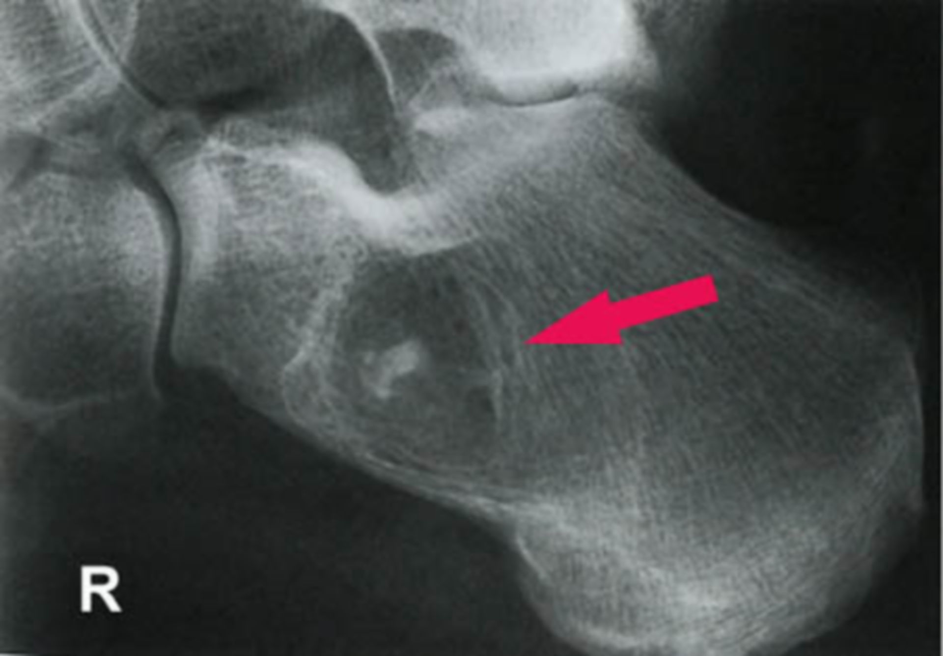 Röntgenaufnahme: Calcaneues