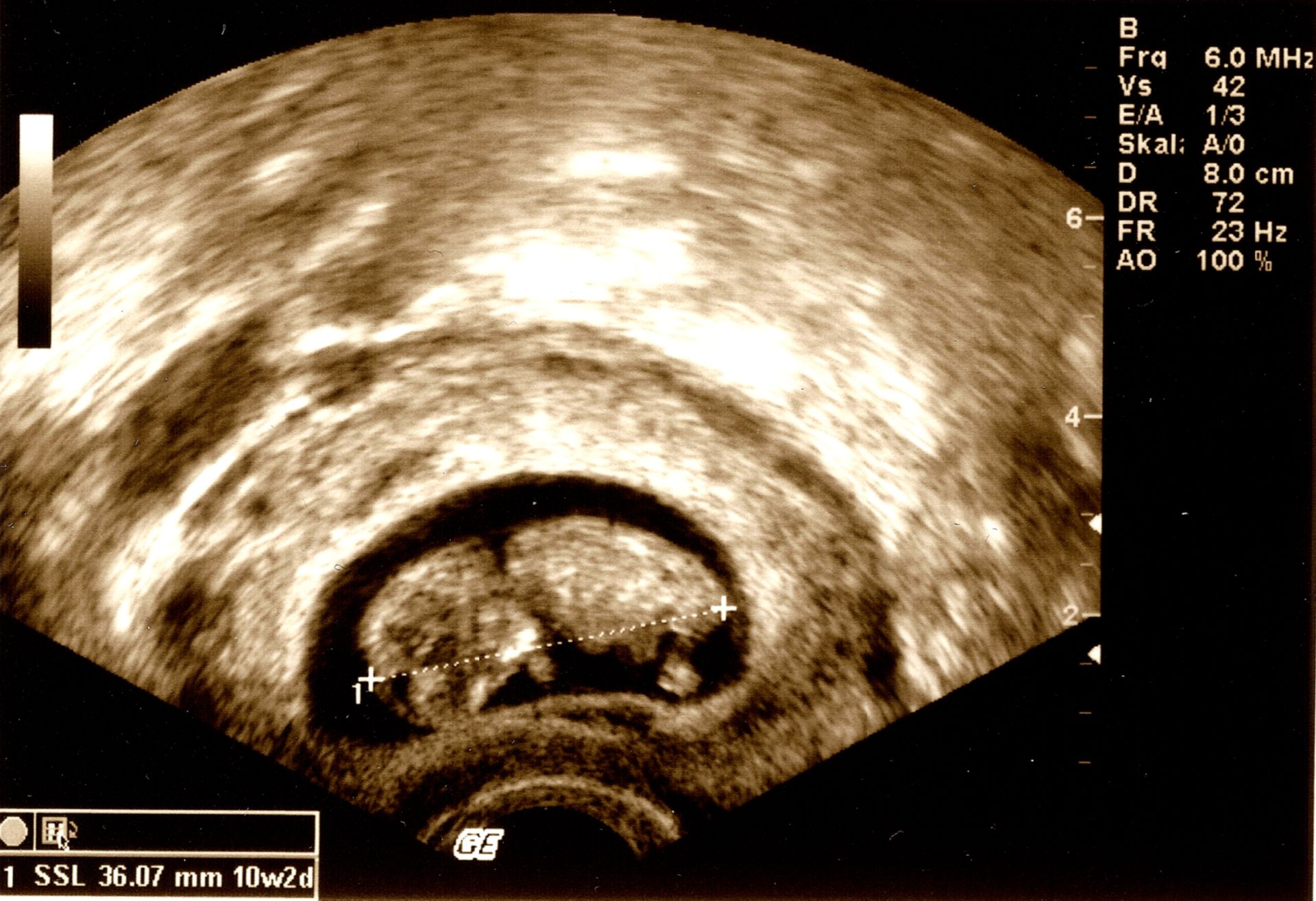Feto de 10 semanas de gestación - ultrasonido