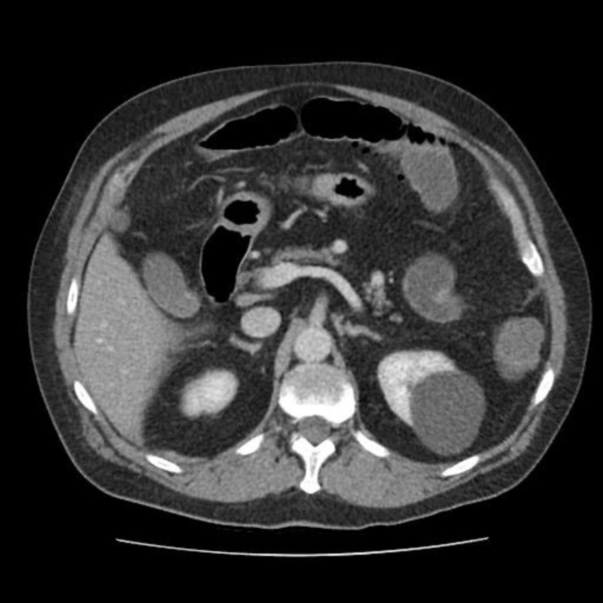 CT des Abdomens in transversaler Ebene mit linksseitiger Nierenzyste