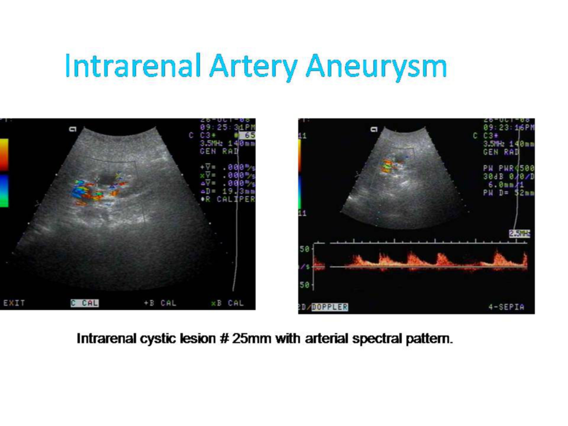 Intrarenal artery aneurysm (1)