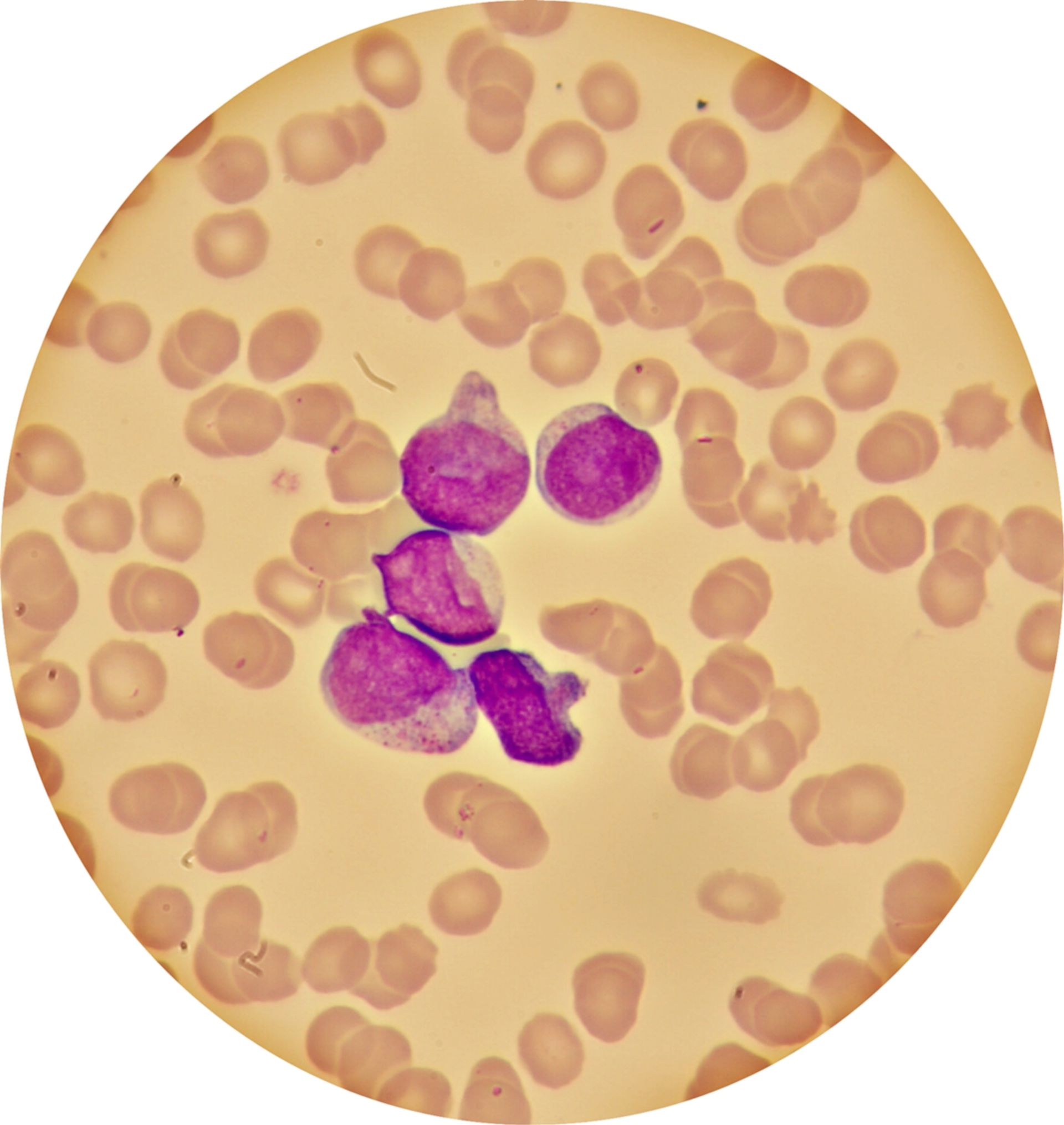 Acute myeloic leukemia - blood smear
