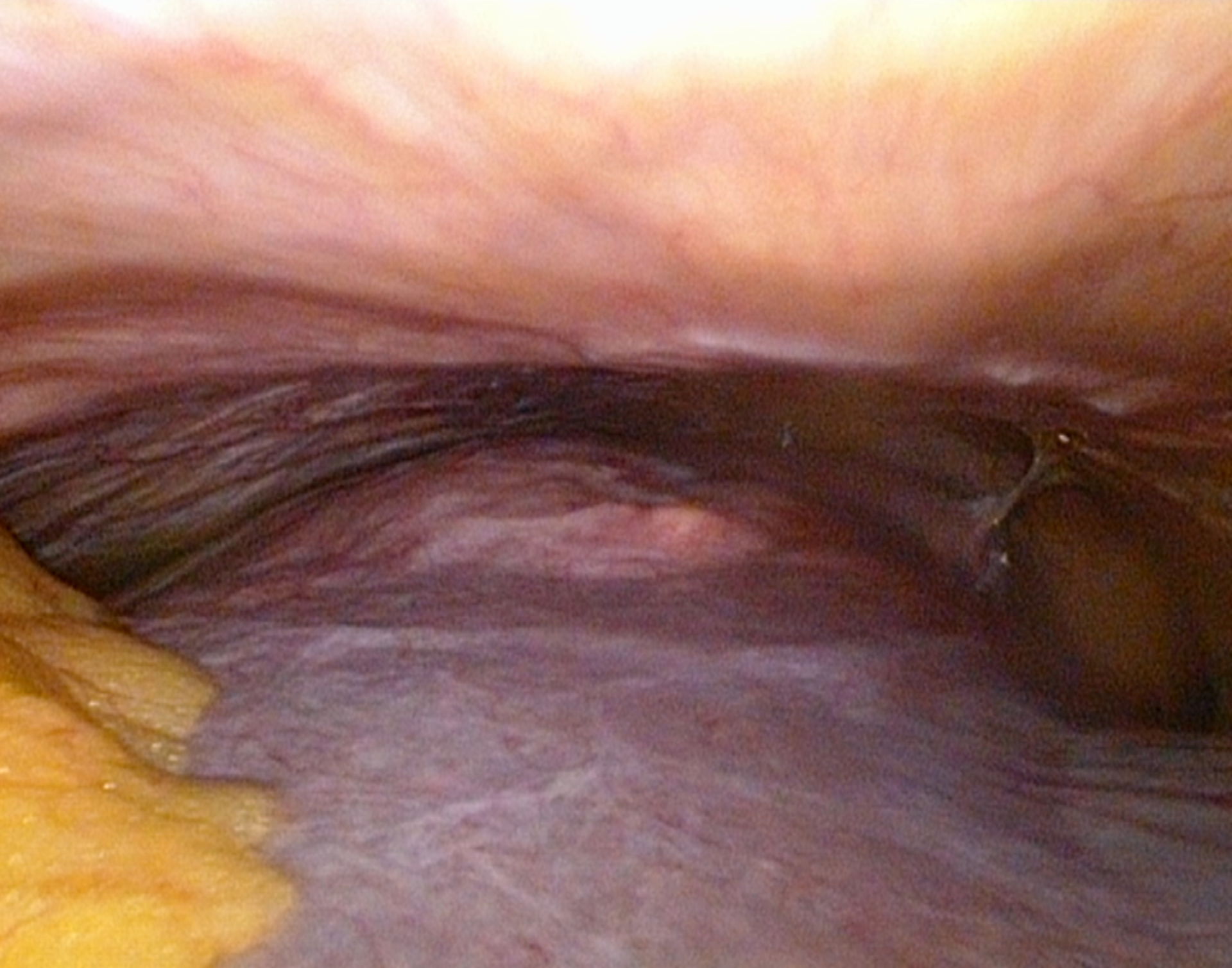 Liver abscess