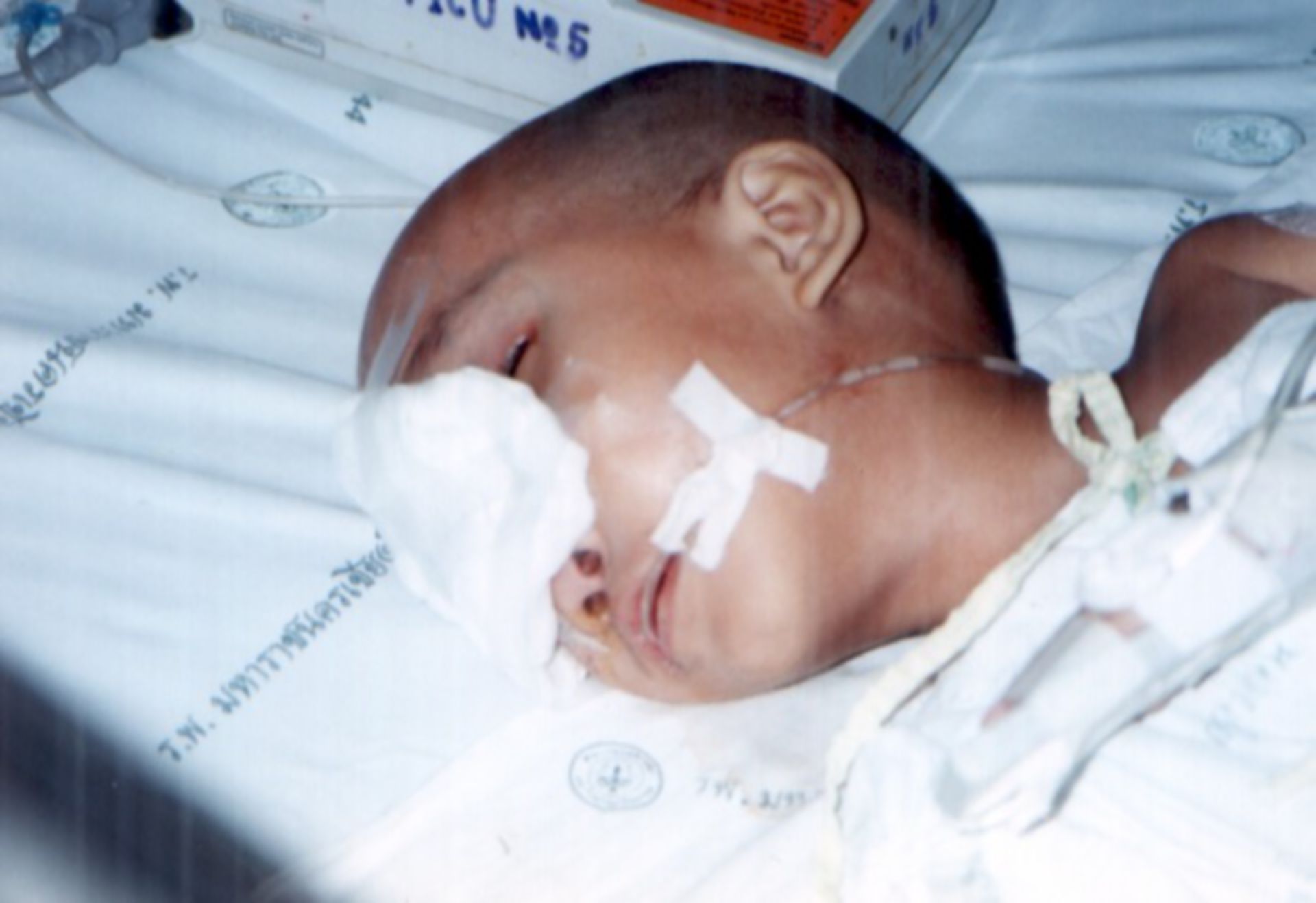 Karen Junge mit Meningomyelozele postoperativ. Er starb an Meningitis.